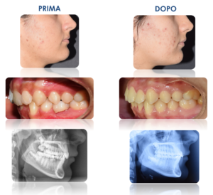 morso profondo ortodonzia di corato