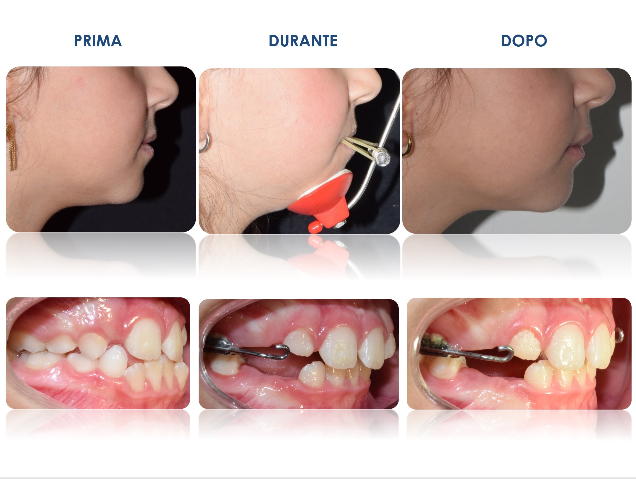 Dentatura mista - Studio Di Corato